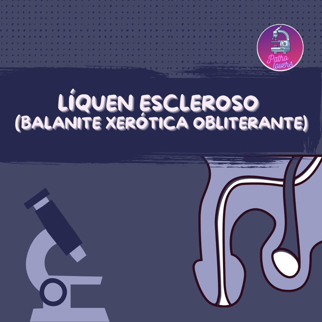 Líquen escleroso (Balanite xerótica obliterante)