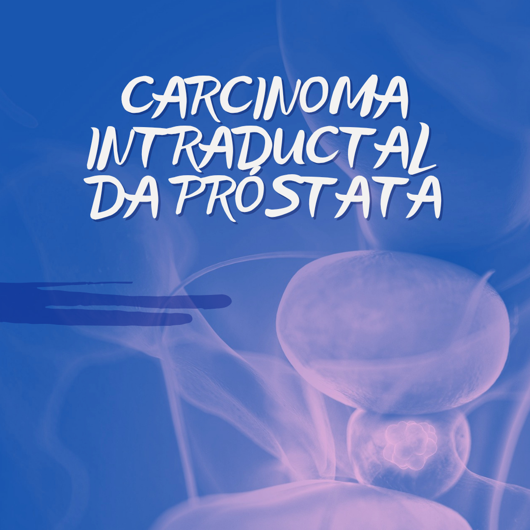 Câncer de Próstata: Adenocarcinoma intraductal prostático