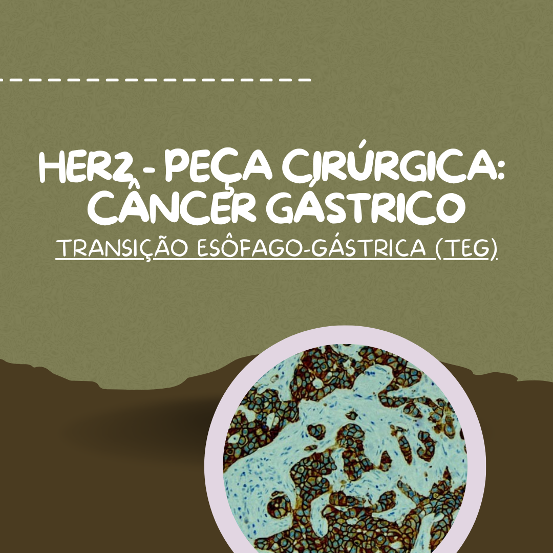 HER2 no Câncer Gástrico (Peça Cirúrgica)